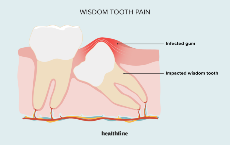 Does Alcohol Help Wisdom Tooth Pain?