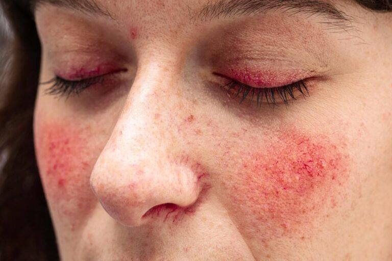 Does Alcohol Make Rosacea Worse?