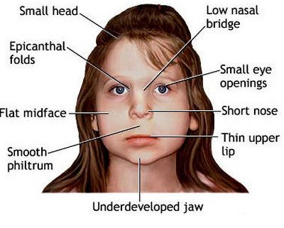 Does Fetal Alcohol Syndrome Cause Autism?