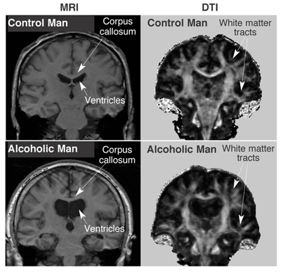 Does Alcohol Affect Mri Scan?