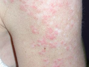 Does Drug Induced Lupus Go Away?